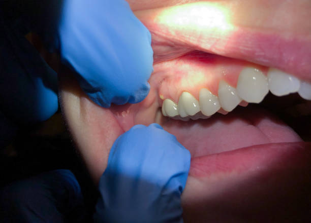 Best Dentist for Tooth Abscess  in , WA