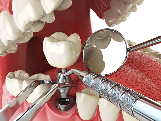 Best Chipped Tooth Repair Near Me  in , WA